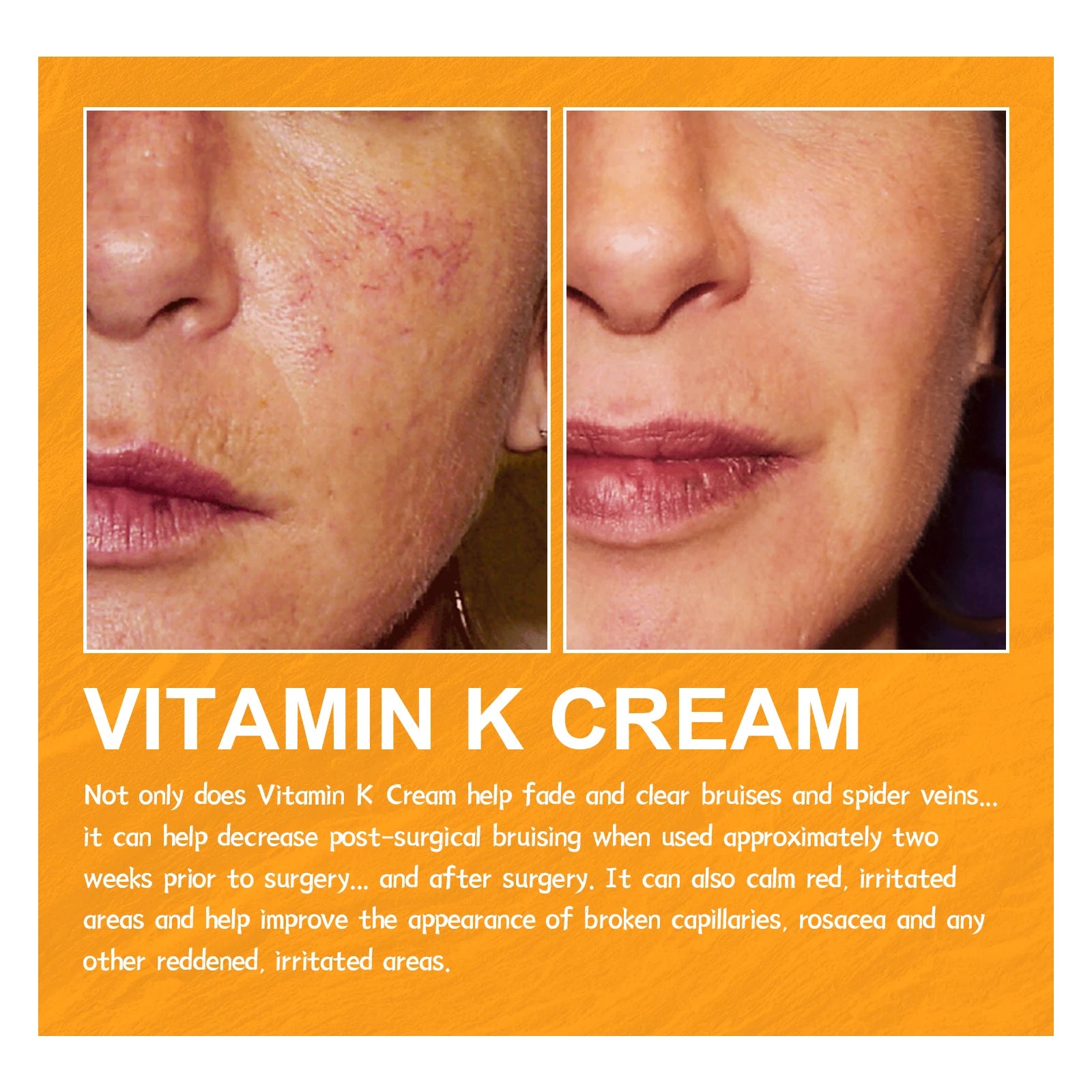 Vitamin K Cream
